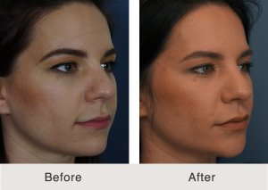 Kulbersh-Rhinoplasty-make-smaller-nose-3
