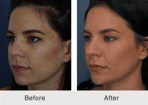 Kulbersh-Rhinoplasty-make-smaller-nose-5