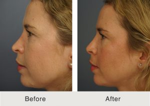 Rinoplastia-facial-4