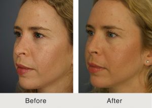 Rinoplastia-facial-5