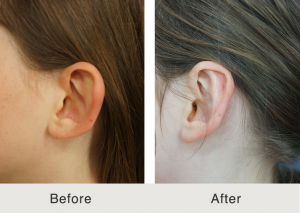 Otoplasty specialist 2 Otoplasty specialist 2
