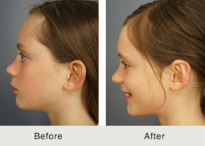 Otoplasty specialist 3 Otoplasty specialist 3
