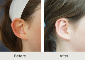 Otoplasty specialist 6 Otoplasty specialist 6
