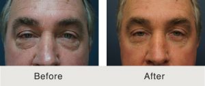 Kulbersh-antes-despues-debajo-de-los-ojos-1-24-19 (1)
