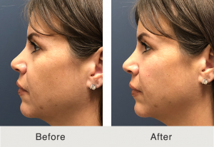 B_A_Tear_trough_fillers_4_24_E