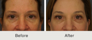lifting-mentonimplant-quimicopeel-MLFG-5