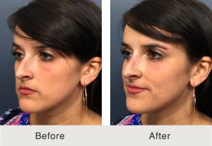 KulbershBeforeAfter4