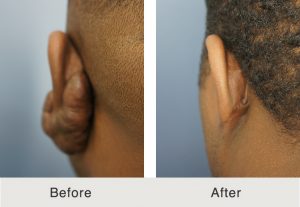 keloid removal in charlotte before and after