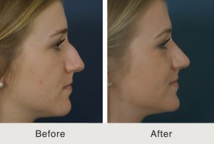 Before and after image of a rhinoplasty procedure done in our Charlotte, NC clinic