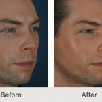 A photo of a man's before and after results after a liquid rhinoplasty procedure performed by Dr. Kulbersh at the Carolina Facial Plastics