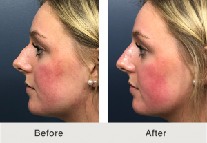 liquid nose job in charlotte, nc