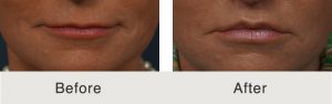 Kulbersh_BeforeAfter_LipLift_Frontal