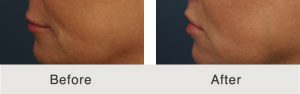 Kulbersh_BeforeAfter_LipLift_Left