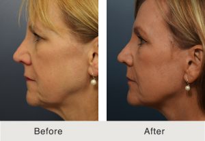 Kulbersh_Before_After_BrowLift_FatGrafting_LowerFace&NeckLift_Left