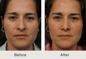 Kulbersh_Before_After_LatinoRhioplasty_FacialFatGrafting_Frontal