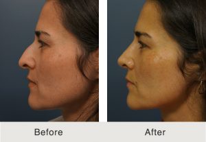 Kulbersh_Before_After_LatinoRhioplasty_FacialFatGrafting_Left