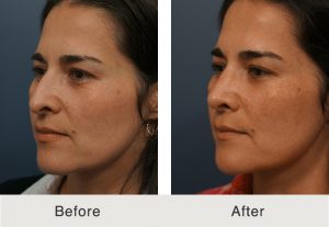 Kulbersh_Before_After_LatinoRhioplasty_FacialFatGrafting_LeftOblique