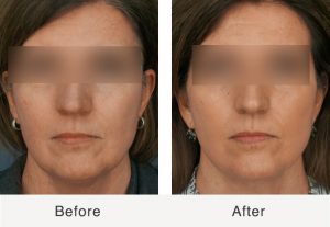Kulbersh_Before_After_LowerFaceNeckLift_Frontal_BLUR female necklift surgery results