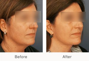neckli necklift results on a female patient