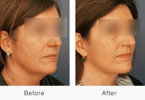 necklift results on a female patient