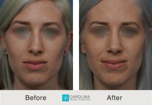 Kulbersh_Before After_Rhinoplasty_Frontal