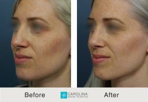 Kulbersh_Before After_Rhinoplasty_LeftOblique