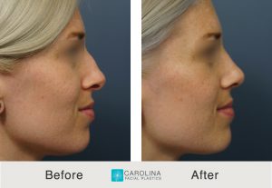 Kulbersh_Before After_Rhinoplasty_Right