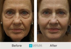 Kulbersh_BeforeAfter_Lower Blepharoplasty_Frontal