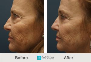Kulbersh_BeforeAfter_Lower Blepharoplasty_Left