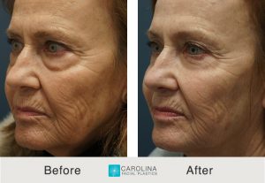 Kulbersh_BeforeAfter_Lower Blepharoplasty_LeftOblique