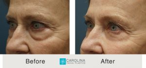 Kulbersh_BeforeAfter_Lower Blepharoplasty_LeftObliqueCloseUp (1)
