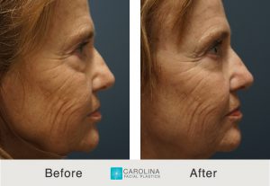 Kulbersh_BeforeAfter_Lower Blepharoplasty_Right