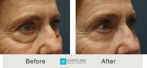 Kulbersh_BeforeAfter_Lower Blepharoplasty_RightObliqueCloseUp