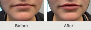 Kulbersh_Vollure_Before_After_Frontal