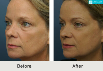 brow lift blepharoplasty before and after