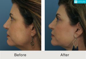 Facelift-brow-lift-fat-grafting-for-facial-rejuvenation-3-Kulbersh