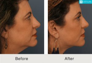 Facelift-brow-lift-fat-grafting-for-facial-rejuvenation-Kulbersh