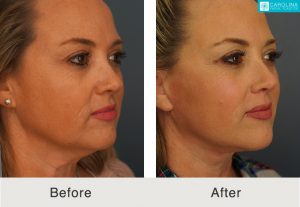Facelift-to-treat-sagging-skin-lower-face-2-Kulbersh
