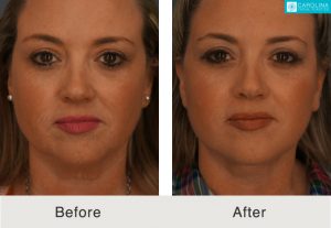 Facelift-to-treat-sagging-skin-lower-face-4-Kulbersh