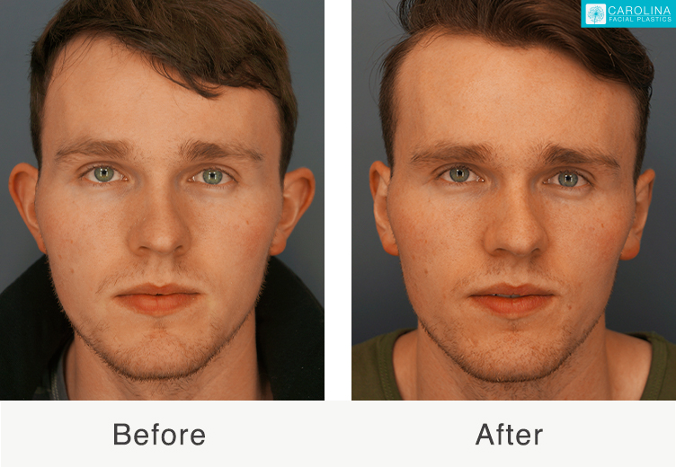 Imagen relevante de Otoplastia