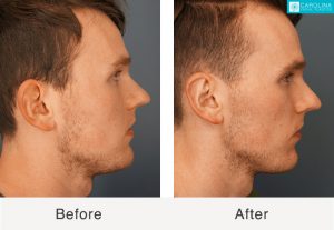 Otoplasty-to-reduce-prominent-ears-4-Kulbersh