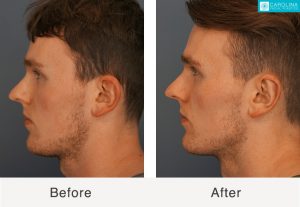 Otoplasty-to-reduce-prominent-ears-Kulbersh