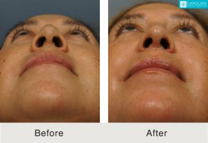 Rhinoplasty-to-correct-nasal-bridge-and-tip-4-Kulbersh