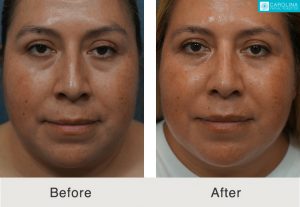 Rhinoplasty-to-correct-nasal-bridge-and-tip-Kulbersh