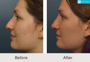 Rhinoplasty-to-straighten-crooked-nasal-bridge-1-Kulbersh