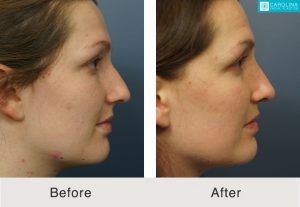 Rhinoplasty-to-straighten-crooked-nasal-bridge-3-Kulbersh