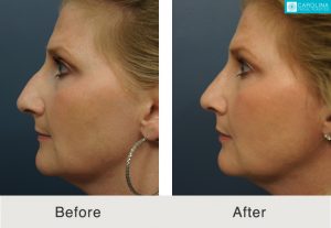 Rhinoplasty-to-straighten-crooked-nose-1-Kulbersh