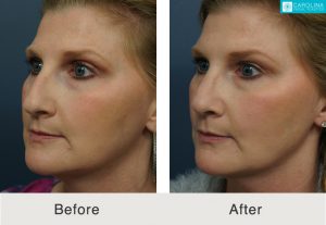 Rhinoplasty-to-straighten-crooked-nose-2-Kulbersh