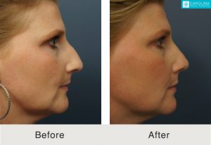 Rhinoplasty-to-straighten-crooked-nose-3-Kulbersh