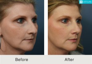 Rhinoplasty-to-straighten-crooked-nose-4-Kulbersh